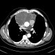 Thymoma, malignant thymoma: CT - Computed tomography